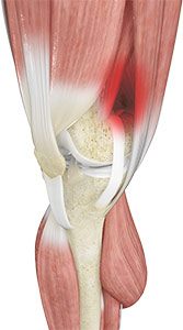 Iliotibial Band Syndrome