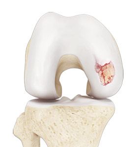 Knee Arthritis