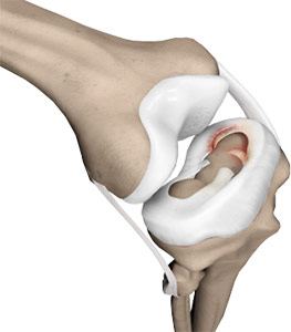 Meniscal Surgery