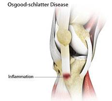 Osgood Schlatter Disease