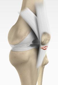 Patella Tendon Rupture