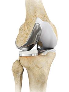 Revision Knee Replacement